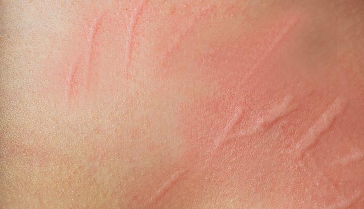 Dermatographia Yang Di Kenal Dengan Kondisi Kulit Langka