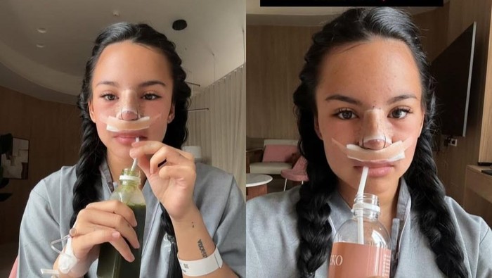 Wajah Baru Shafa Harris Usai Oplas: Gak Nyangka Secantik Ini!