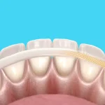 Solusi Jitu Biar Gigi Goyang Gak Jadi Tanggal